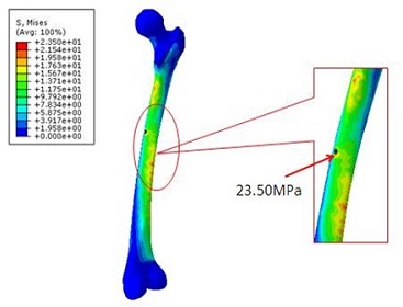 深圳某健康實(shí)業(yè)有限公司股骨有限元分析